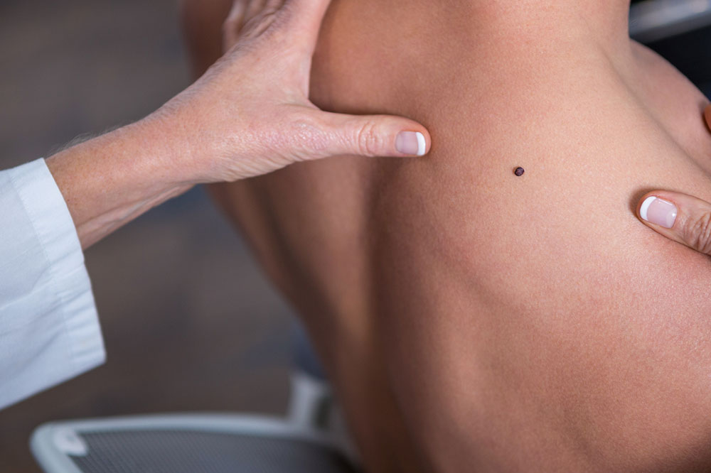 6 Tips to Prevent the Onset of Melanoma